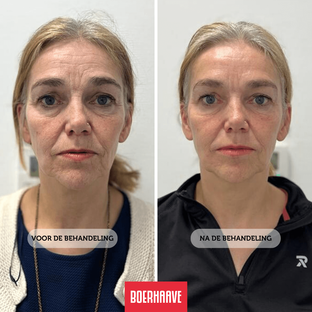 Spuiten & prikken Beau Mondes Marique probeerde botox